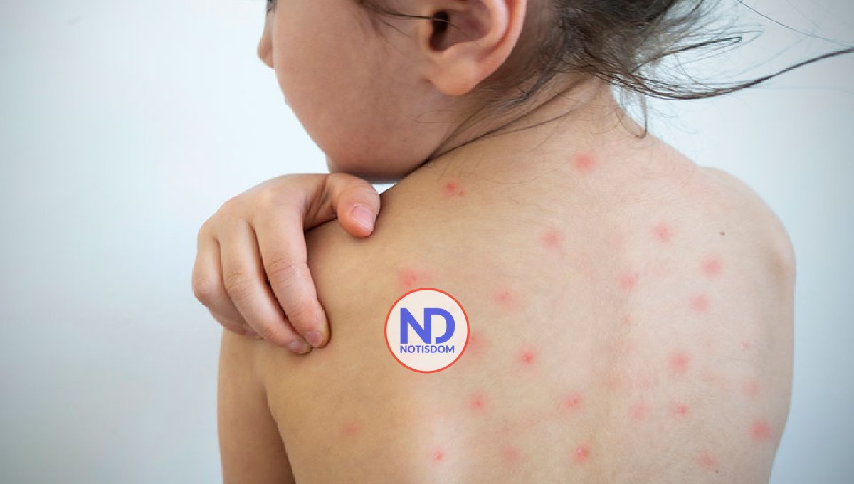 Exhortan a Salud Pública realizar campañas de vacunación para evitar brote de sarampión 2 Exhortan a Salud Pública realizar campañas de vacunación para evitar brote de sarampión