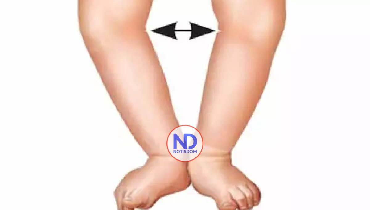 Mi hijo nació con piernas en arco, ¿se podría mejorar con masajes o es necesario una cirugía?