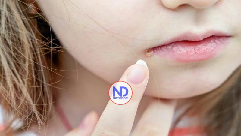 ¿En qué tiempo salen los síntomas después de haber contraído el virus de herpes labial?