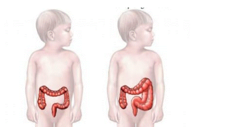 Megacolon congénito, una enfermedad poco conocida que afecta a decenas de niños en el país 4 MEGACOLON 1 Megacolon congénito, una enfermedad poco conocida que afecta a decenas de niños en el país