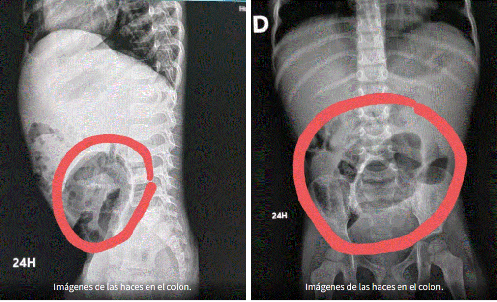 Megacolon congénito, una enfermedad poco conocida que afecta a decenas de niños en el país 3 MEGACOLON 2 Megacolon congénito, una enfermedad poco conocida que afecta a decenas de niños en el país