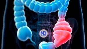 Megacolon congénito, una enfermedad poco conocida que afecta a decenas de niños en el país