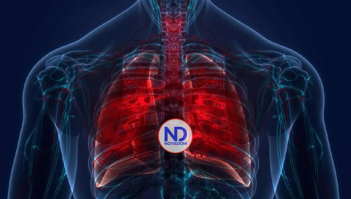 El Servicio Nacional de Salud reporta 763 casos de tuberculosis en lo que va de año