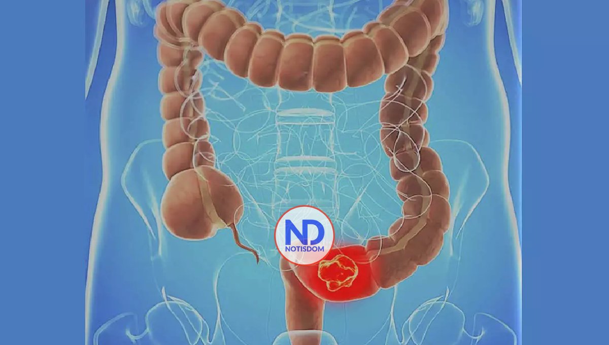 El cáncer de colon rectal en aumento en menores de 50 años