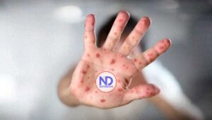 La única forma de prevenir el sarampión es con las vacunas, advierte pediatra