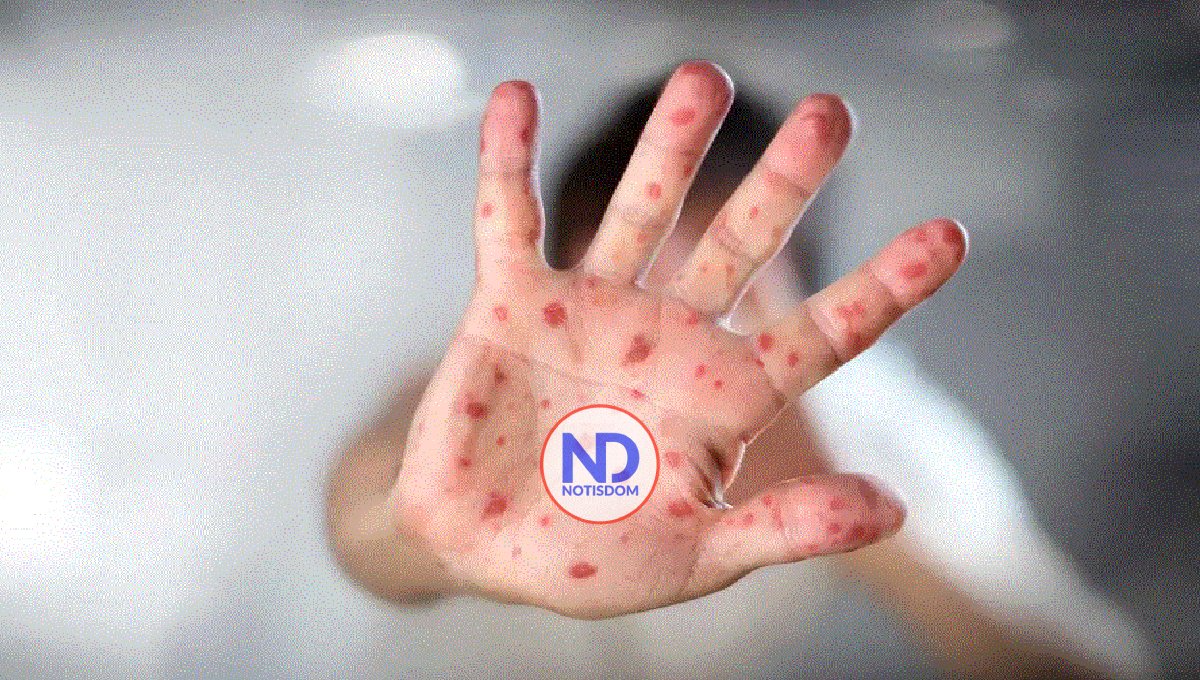 La única forma de prevenir el sarampión es con las vacunas, advierte pediatra