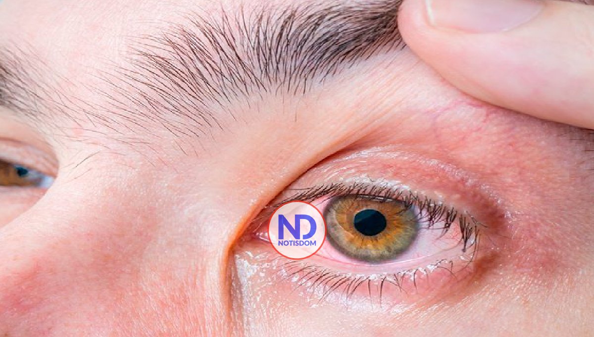 Causas de la conjuntivitis 2 Causas de la conjuntivitis