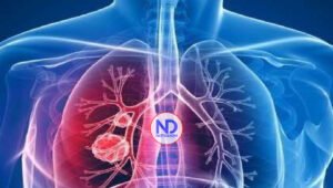 Fibrosis quística enfermedad genética grave