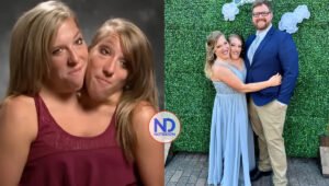 Cómo es la vida sexual de los gemelos unidos