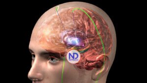 La estimulación cerebral profunda ofrece esperanza a pacientes con Parkinson