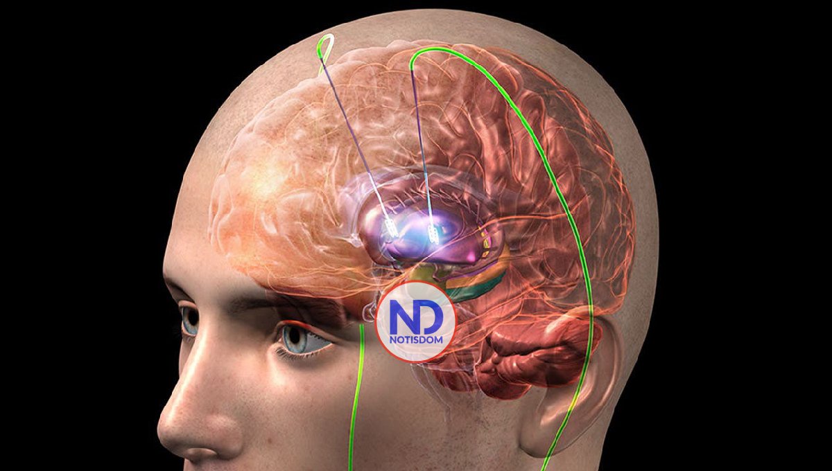 La estimulación cerebral profunda ofrece esperanza a pacientes con Parkinson
