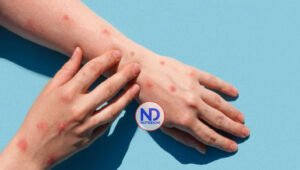 MSP confirma hay 6 casos sospechosos de viruela sísmica