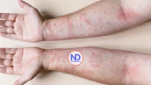 Día Mundial del Lupus, una enfermedad que carcome por dentro