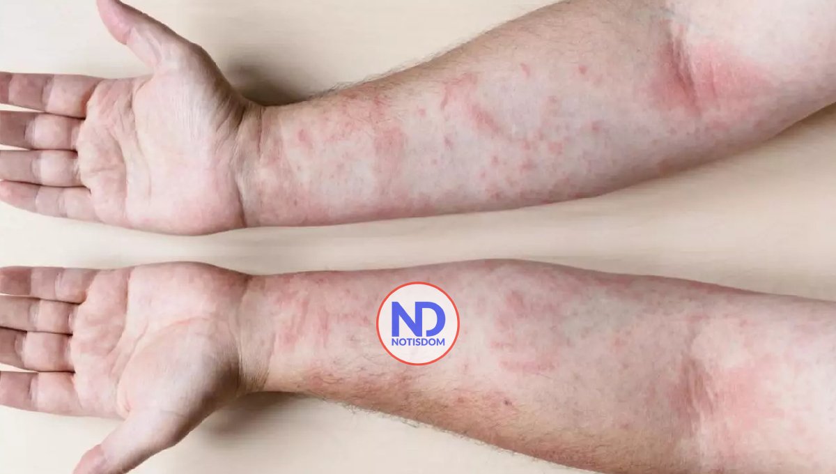 Día Mundial del Lupus, una enfermedad que carcome por dentro