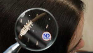 Descubren que los piojos del cuerpo humano son potentes transmisores de la peste