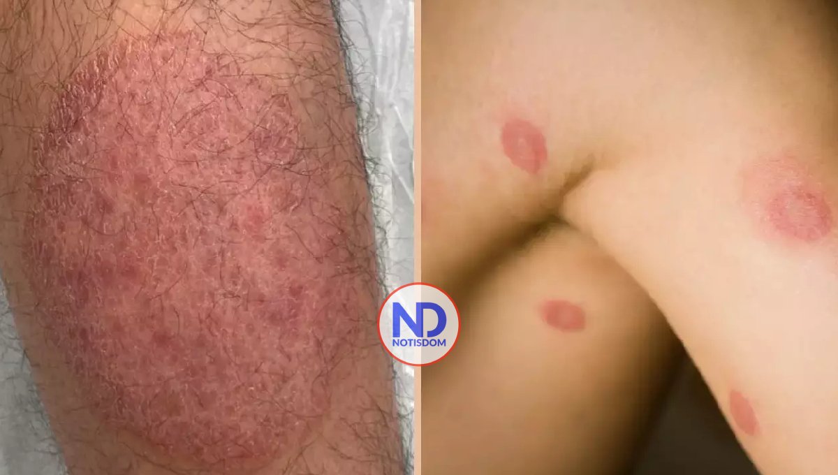 Detectan en Estados Unidos nueva infección fúngica de transmisión sexual 