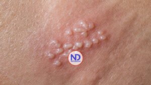 ¿El herpes genital es peligroso?