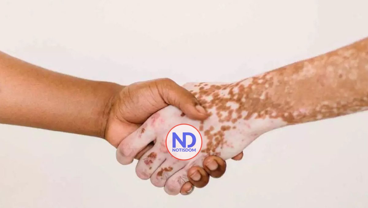 Día Mundial del Vitiligo, una anomalía estética no aceptada