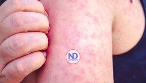 RD ha reportado 170 casos de sarampión en lo que va de año