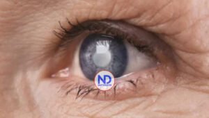 La catarata: causa de la ceguera en un 60% actualmente