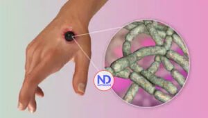 Principales formas de contagio y síntomas del ántrax