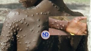 OMS prepara alerta internacional por viruela del mono tras 460 muertes este año en África