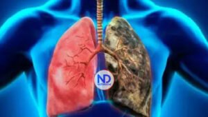 ¿Cuáles son los síntomas del cáncer de pulmón?