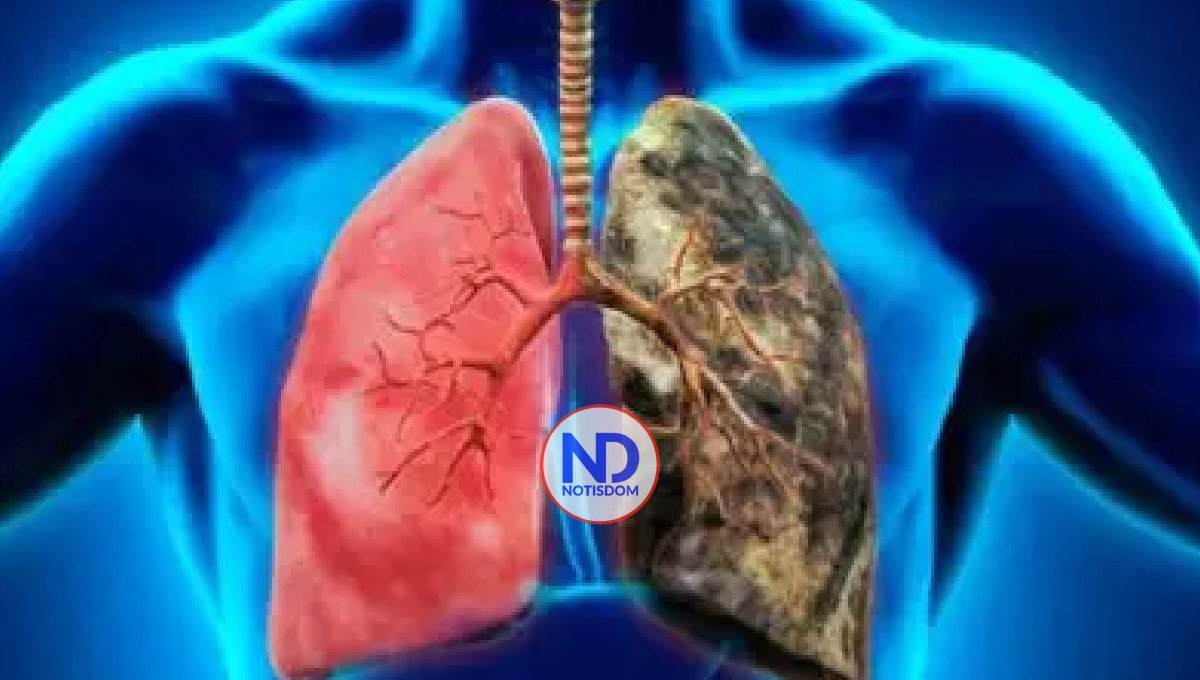 ¿Cuáles son los síntomas del cáncer de pulmón?