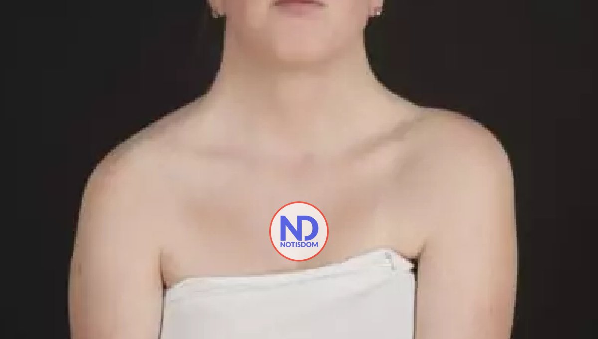 Síndrome de Turner afecta a una de cada 2,500 mujeres en el mundo