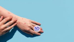 OMS podría convocar al Comité de Emergencias para evaluar brotes de viruela del mono