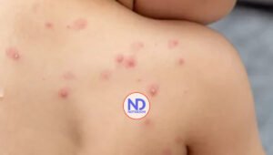 ¿Cuáles son los principales síntomas para detectar la viruela del mono?