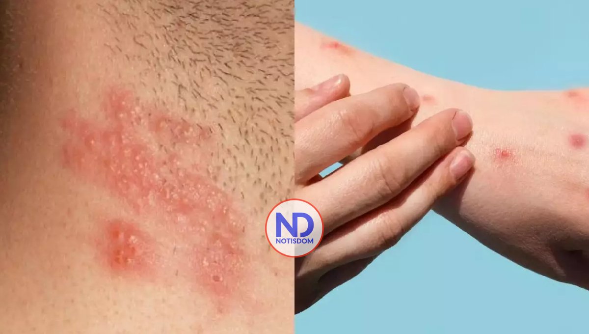 Salud Pública aclara paciente en Azua tiene herpes, no viruela del mono