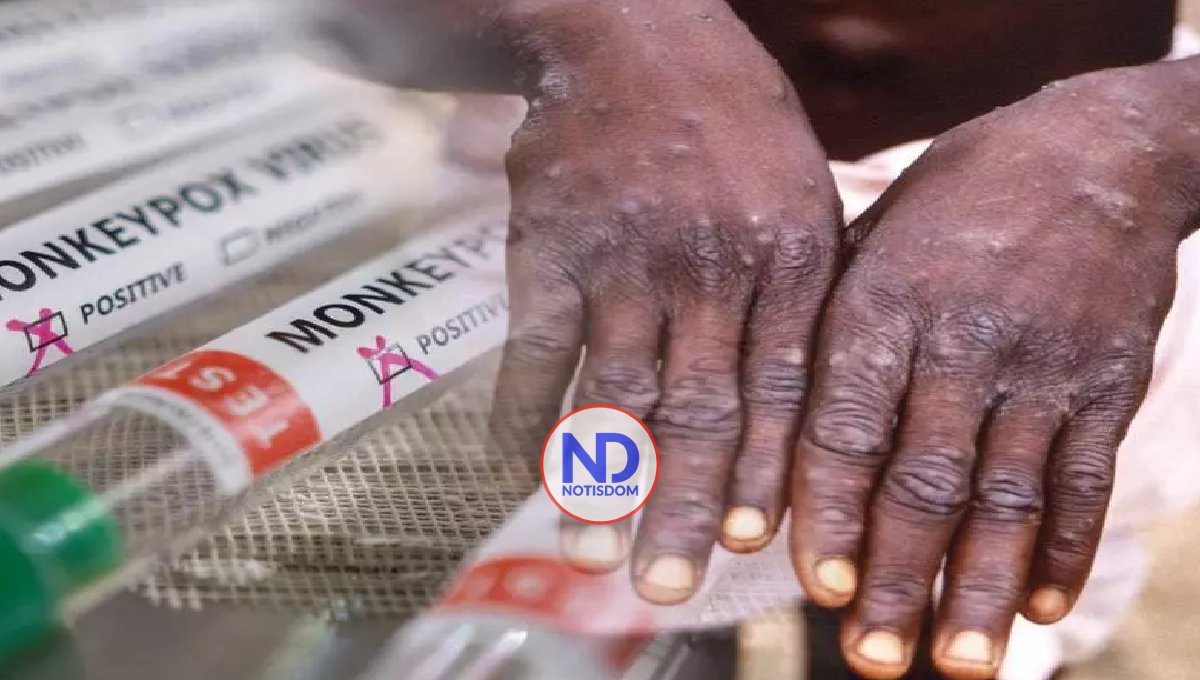 Viruela del mono deja 622 muertos en África; esperan la llegada de vacunas