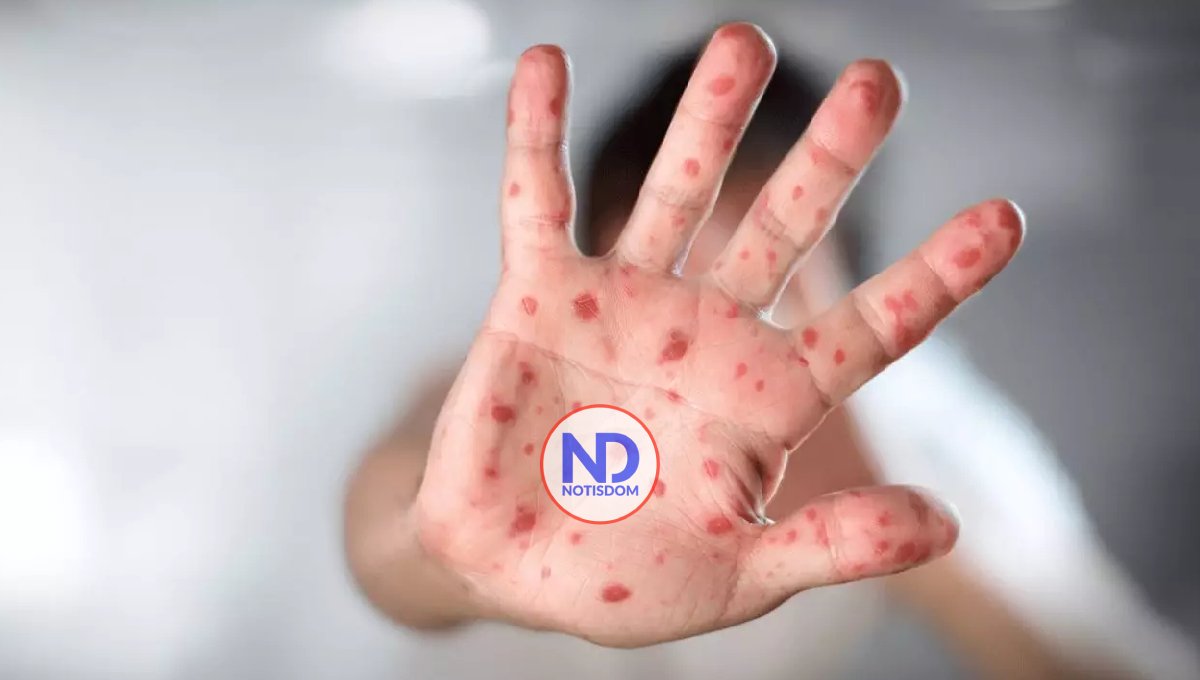 OMS transmite tranquilidad ante brote de mpox en África 2 OMS transmite tranquilidad ante brote de mpox en África