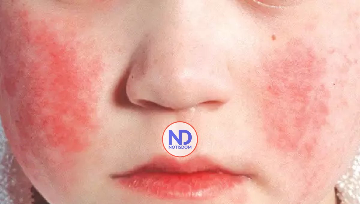 Qué es la “quinta enfermedad” y por qué están creciendo los casos