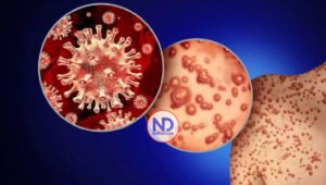 Detectan en Suecia primer caso de viruela del mono fuera de África