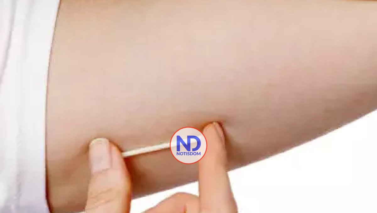 Uso del anticonceptivo sub-dérmico