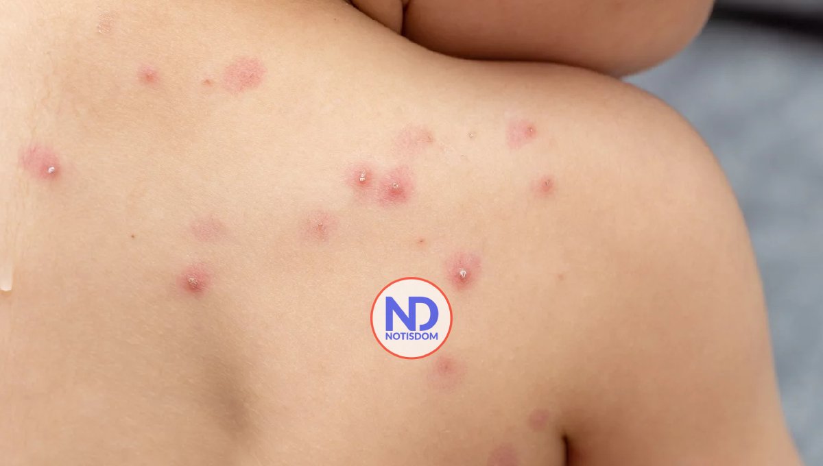 Alarma en Los Praditos por caso sospechoso de viruela del mono