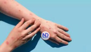 MP dice no hay casos confirmados de “viruela del mono” en RD