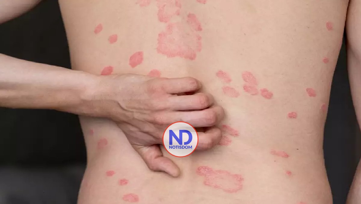 El impacto oculto de la psoriasis: más allá de una enfermedad en la piel