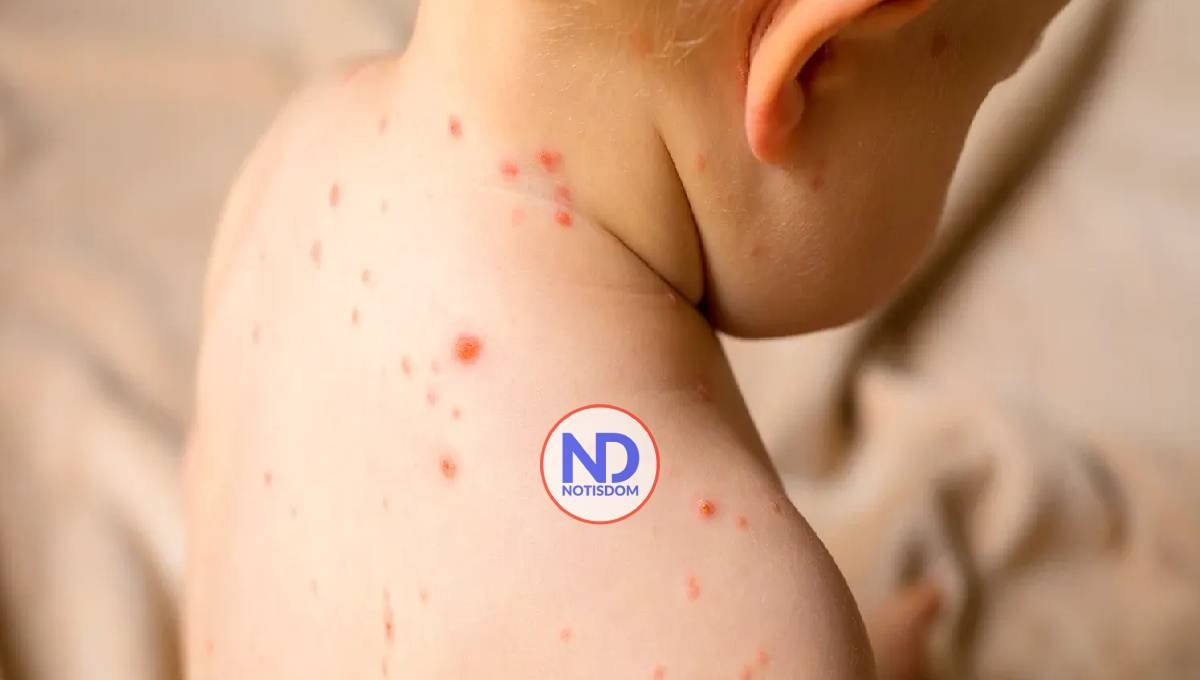 ¿Cómo diferenciar la varicela de otras enfermedades que se manifiestan en la piel? 2 ¿Cómo diferenciar la varicela de otras enfermedades que se manifiestan en la piel?