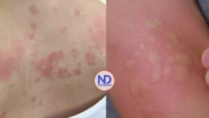 La urticaria y el exantema son dos tipos de erupciones cutáneas