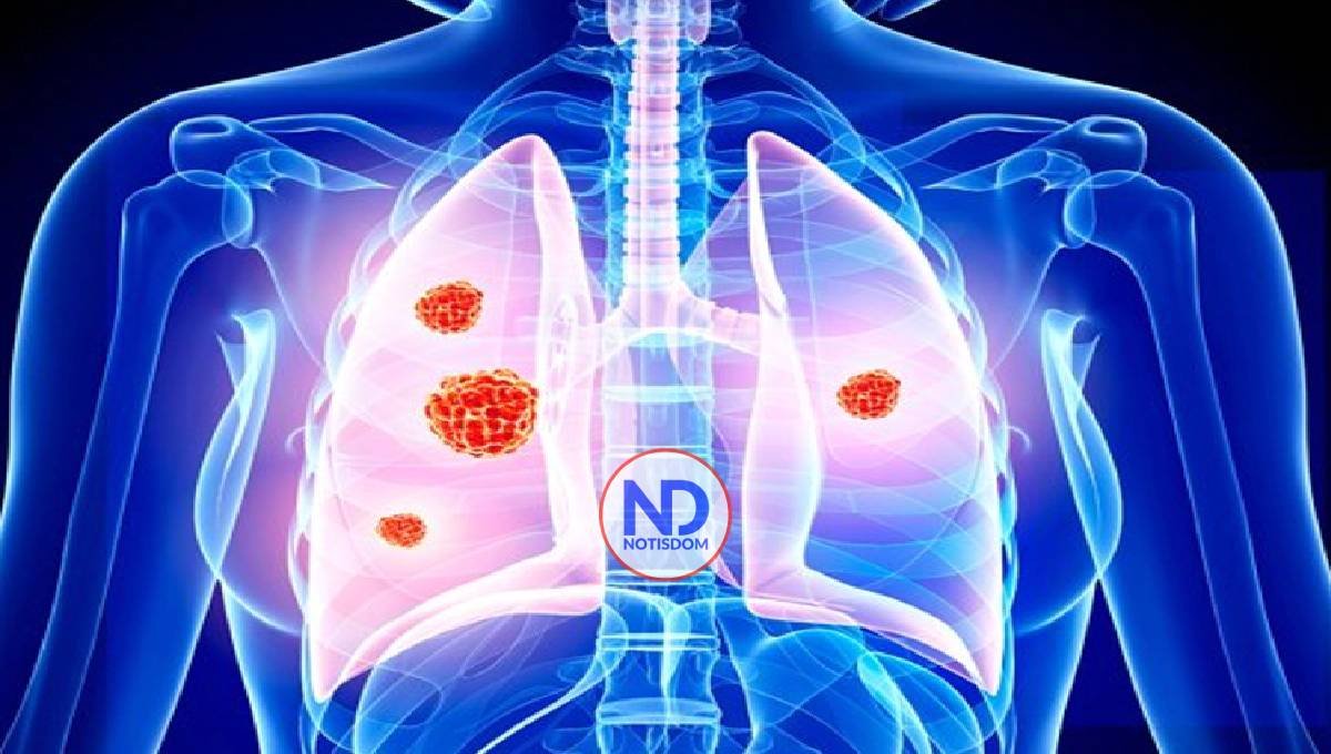 La OMS alerta sobre medicamento falsificado para tratar el cáncer de pulmón no microcítico