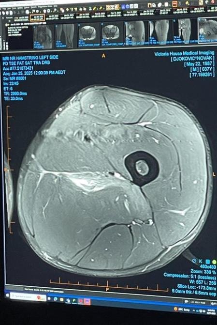 Djokovic enseña la resonancia de la lesión que le retiró ante Zverev 3 Djokovic ensena la resonancia con la lesion Djokovic enseña la resonancia de la lesión que le retiró ante Zverev