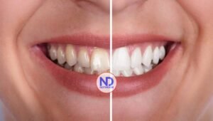 ¿Qué bebida o alimento mancha más los dientes?