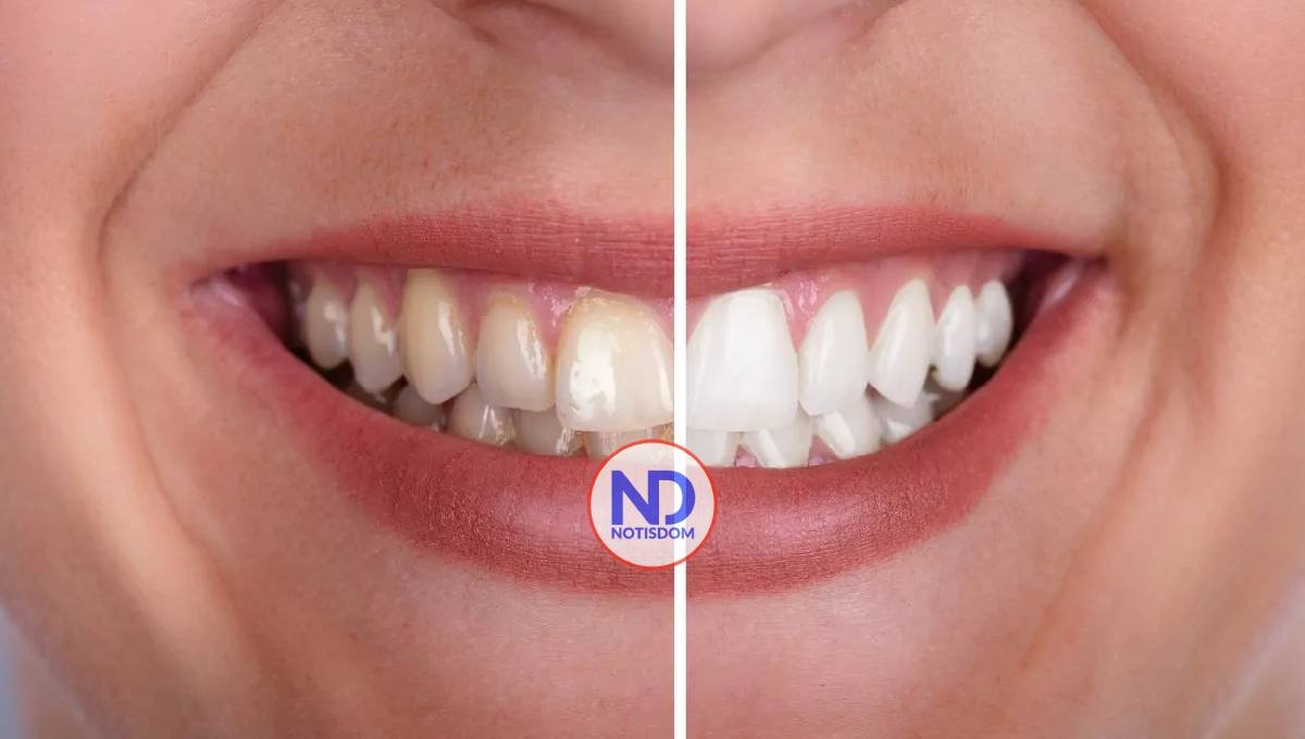 ¿Qué bebida o alimento mancha más los dientes?