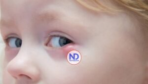 Señales de obstrucción del conducto lagrimal