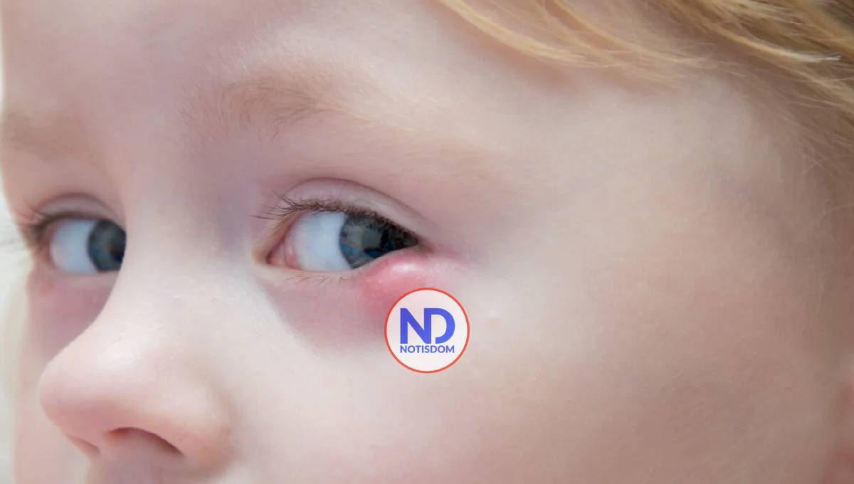 Señales de obstrucción del conducto lagrimal