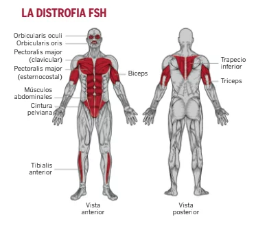DISTROFIA En el Día de las Enfermedades Raras conoce sobre la distrofia muscular