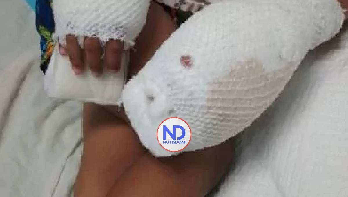 Recibe alta médica niño de cuatro años quemado por su madre